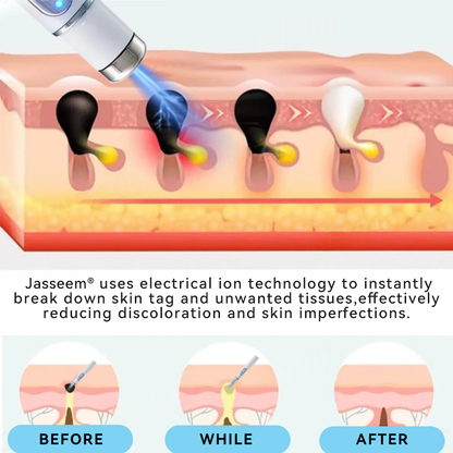 𝐉𝐚𝐬𝐬𝐞𝐞𝐦® Medical-Grade Laser Pen 💕 (Powered by CO₂ laser technology – effectively removes moles, warts, skin tags, pigmentation marks, and other skin imperfections)🏆