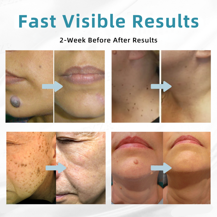 𝐉𝐚𝐬𝐬𝐞𝐞𝐦® Medical-Grade Laser Pen 💕 (Powered by CO₂ laser technology – effectively removes moles, warts, skin tags, pigmentation marks, and other skin imperfections)🏆