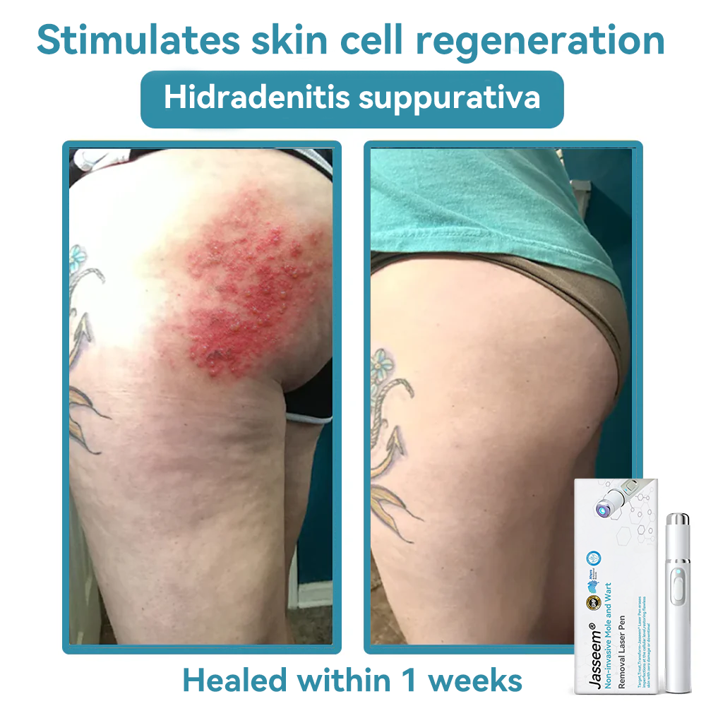 𝐉𝐚𝐬𝐬𝐞𝐞𝐦® Medical-Grade Laser Pen 💕 (Powered by CO₂ laser technology – effectively removes moles, warts, skin tags, pigmentation marks, and other skin imperfections)🏆