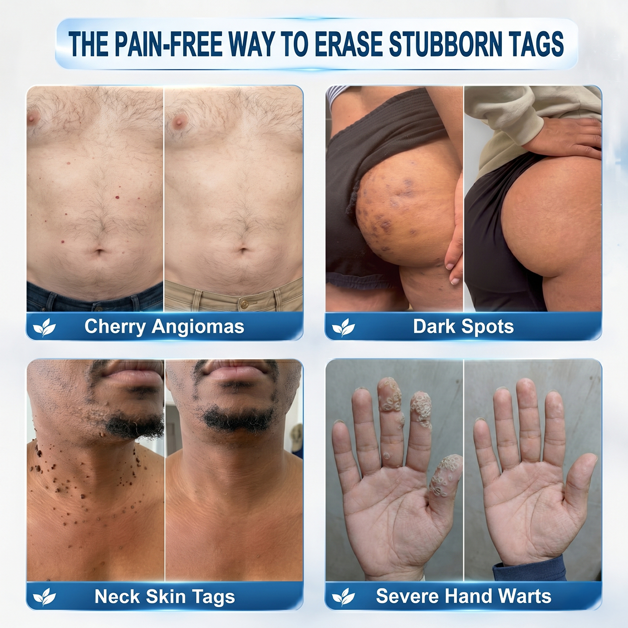 𝐏i𝐜𝐝o® 7-𝐷𝑎𝑦 𝗧𝐚𝐠 & 𝗦𝗽𝐨𝐭 𝐄𝐫𝒂𝒔𝒆𝒓(Zero Pain, Zero 𝐒𝐜𝐚𝒓𝒔 Rollerball)👕