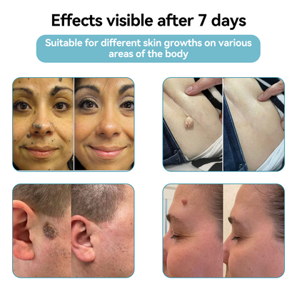 𝐉𝐚𝐬𝐬𝐞𝐞𝐦® Medical-Grade Laser Pen 💕 (Powered by CO₂ laser technology – effectively removes moles, warts, skin tags, pigmentation marks, and other skin imperfections)🏆