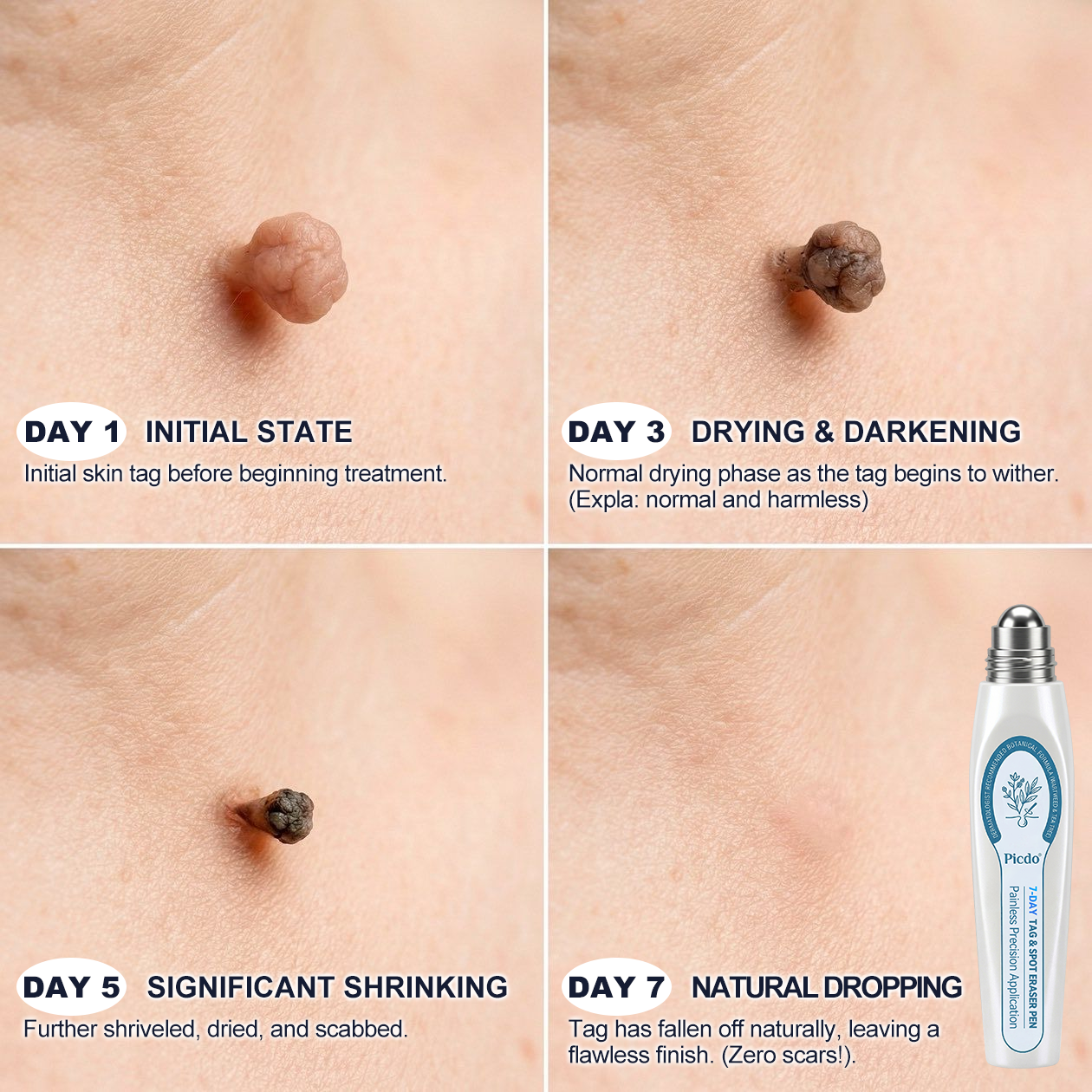 𝐏i𝐜𝐝o® 7-𝐷𝑎𝑦 𝗧𝐚𝐠 & 𝗦𝗽𝐨𝐭 𝐄𝐫𝒂𝒔𝒆𝒓(Zero Pain, Zero 𝐒𝐜𝐚𝒓𝒔 Rollerball)👕