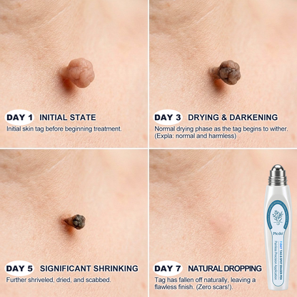 𝐏i𝐜𝐝o® 7-𝐷𝑎𝑦 𝗧𝐚𝐠 & 𝗦𝗽𝐨𝐭 𝐄𝐫𝒂𝒔𝒆𝒓(Zero Pain, Zero 𝐒𝐜𝐚𝒓𝒔 Rollerball)👕